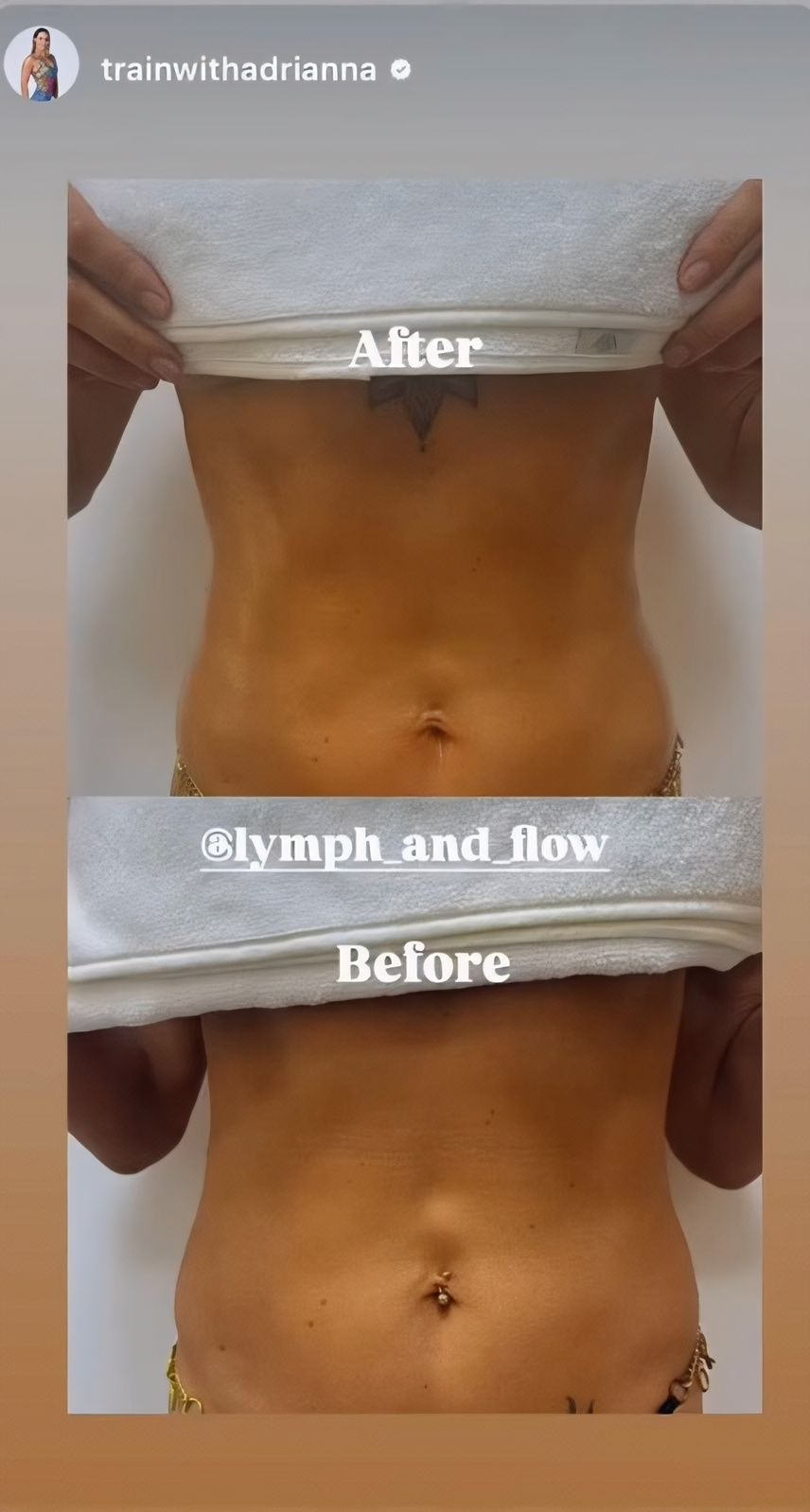 Arms post-operative recovery
