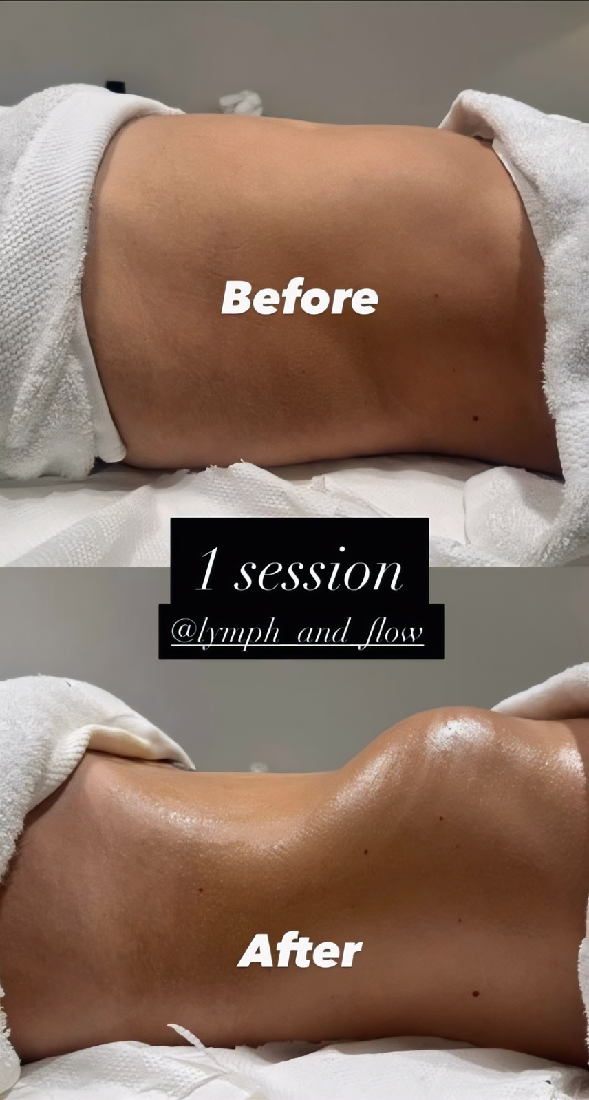 Arms post-operative recovery