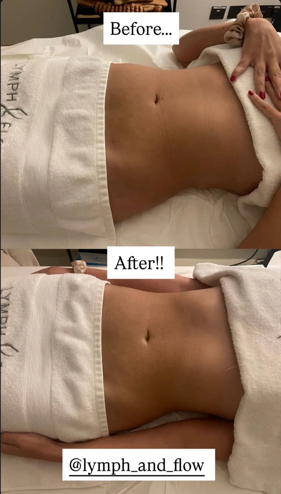 Arms post-operative recovery